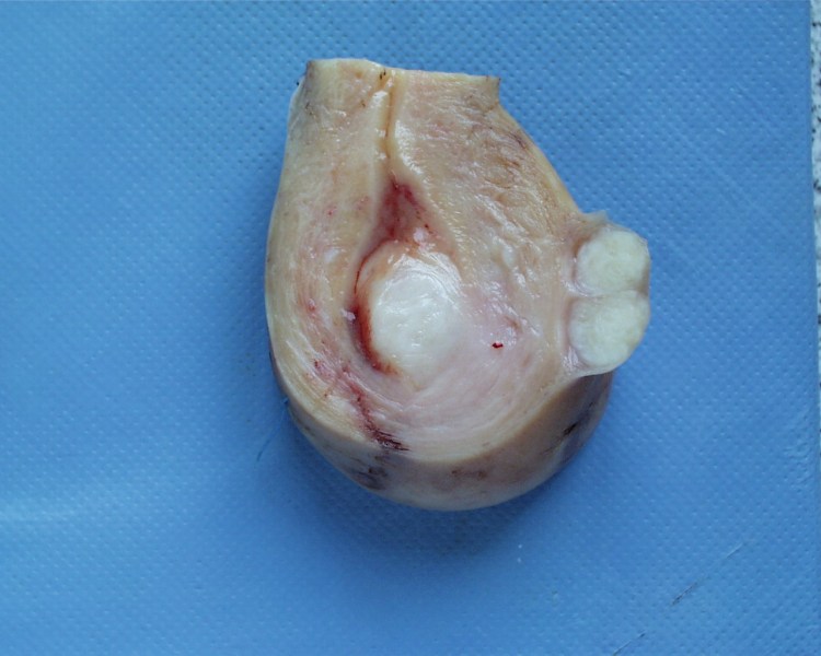 Miom+Maternice Miom Maternice http://mikromed.uniri.hr/atlas/novotvorine%201.html